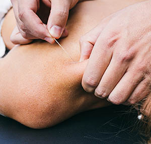Superior Physical Therapy - Dry Needling