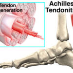 foot achilles tendon